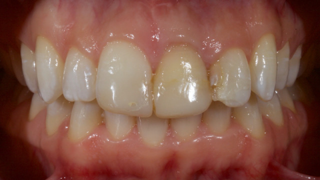 Ultra-Conservative Management of the Discolored Tooth
