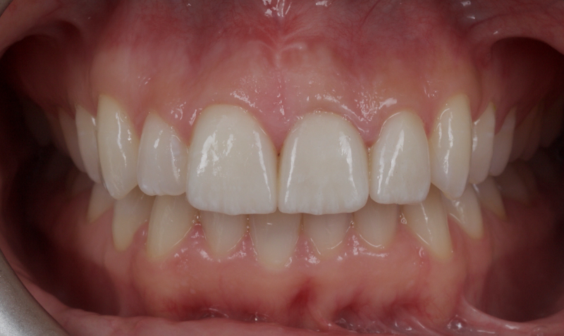 Ultra-Conservative Management of the Discolored Tooth Smithson ultra conservative management discolored 02