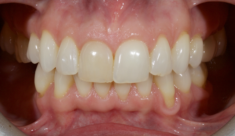 Ultra-Conservative Management of the Discolored Tooth Smithson ultra conservative management discolored 03