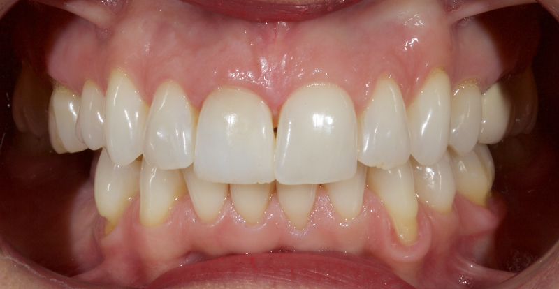 Ultra-Conservative Management of the Discolored Tooth Smithson ultra conservative management discolored 04