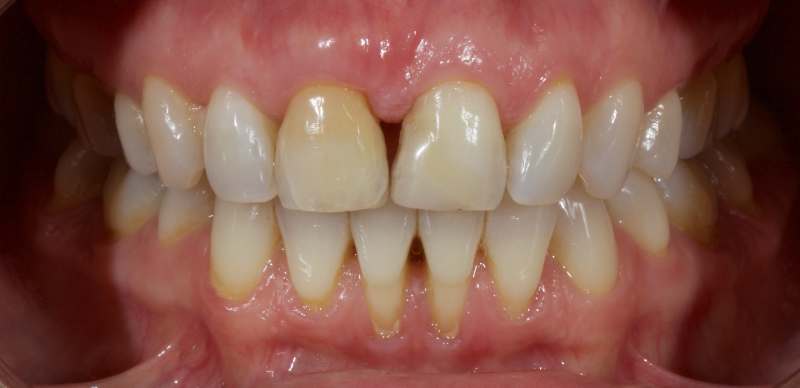 Ultra-Conservative Management of the Discolored Tooth Smithson ultra conservative management discolored 06