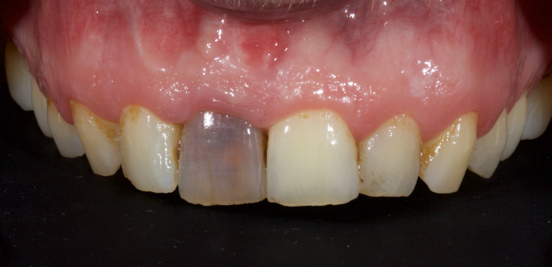 Ultra-Conservative Management of the Discolored Tooth Smithson ultra conservative management discolored 07