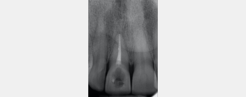 Ultra-Conservative Management of the Discolored Tooth Smithson ultra conservative management discolored 08