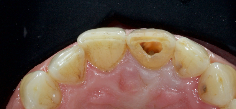Ultra-Conservative Management of the Discolored Tooth Smithson ultra conservative management discolored 09