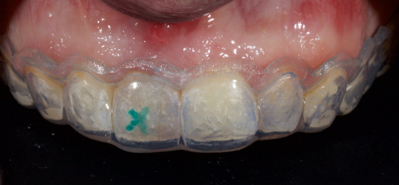 Ultra-Conservative Management of the Discolored Tooth Smithson ultra conservative management discolored 10