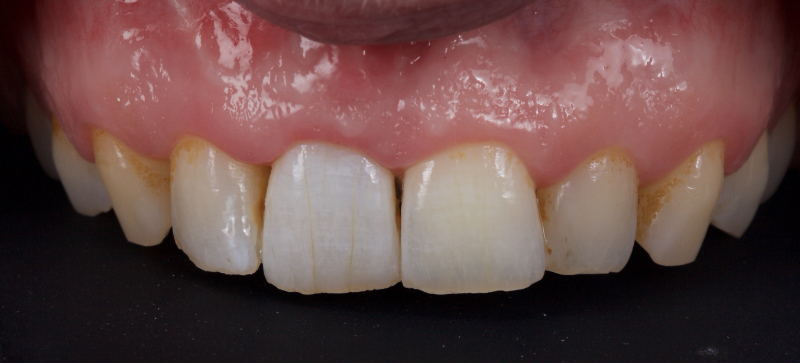 Ultra-Conservative Management of the Discolored Tooth Smithson ultra conservative management discolored 11