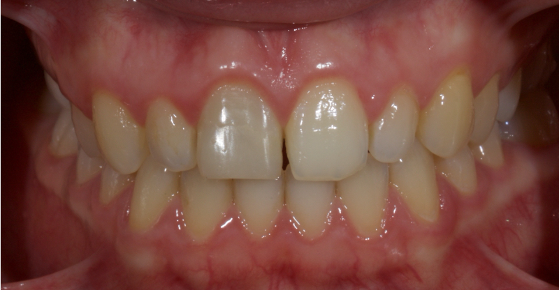 Ultra-Conservative Management of the Discolored Tooth Smithson ultra conservative management discolored 12