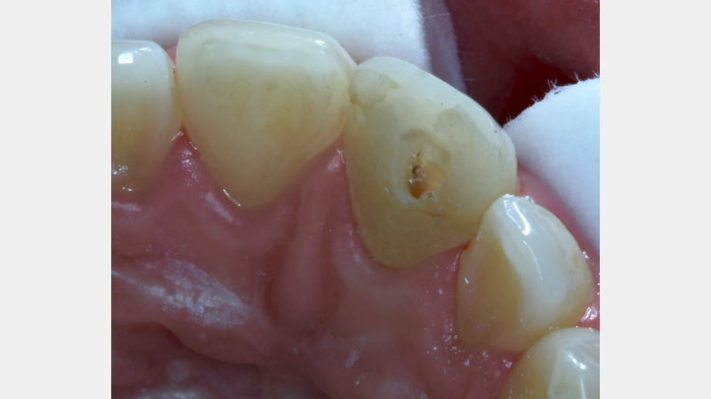 Ultra-Conservative Management of the Discolored Tooth Smithson ultra conservative management discolored 13