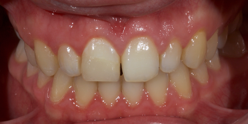 Ultra-Conservative Management of the Discolored Tooth Smithson ultra conservative management discolored 15