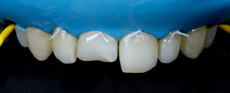 Ultra-Conservative Management of the Discolored Tooth Smithson ultra conservative management discolored 16
