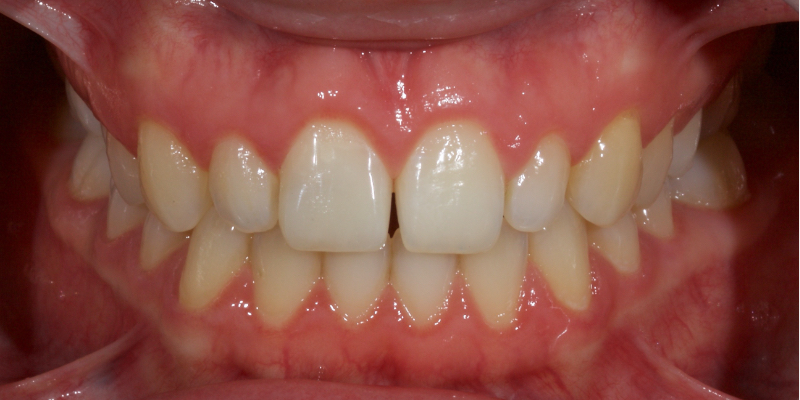 Ultra-Conservative Management of the Discolored Tooth Smithson ultra conservative management discolored 17