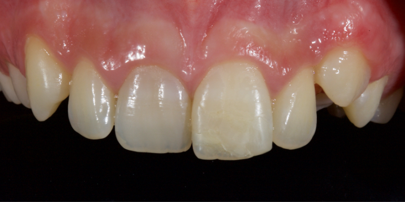 Ultra-Conservative Management of the Discolored Tooth Smithson ultra conservative management discolored 18