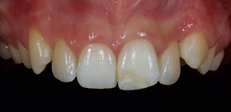 Ultra-Conservative Management of the Discolored Tooth Smithson ultra conservative management discolored 19