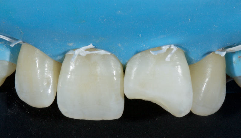 Ultra-Conservative Management of the Discolored Tooth Smithson ultra conservative management discolored 20