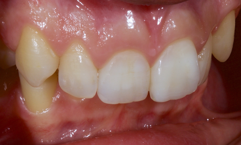 Ultra-Conservative Management of the Discolored Tooth Smithson ultra conservative management discolored 21