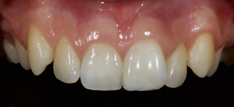 Ultra-Conservative Management of the Discolored Tooth Smithson ultra conservative management discolored 22