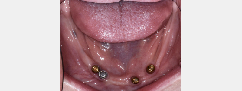 Where Is the Line With Locators? Benting where is line locators 03