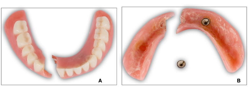 Oh Snap! Managing a Fractured Denture Base Dichter managing fractured denture base 02