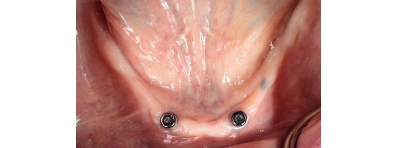 Oh Snap! Managing a Fractured Denture Base Dichter managing fractured denture base 03