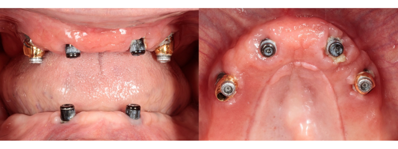 Oh Snap! Managing a Fractured Denture Base Dichter managing fractured denture base 04