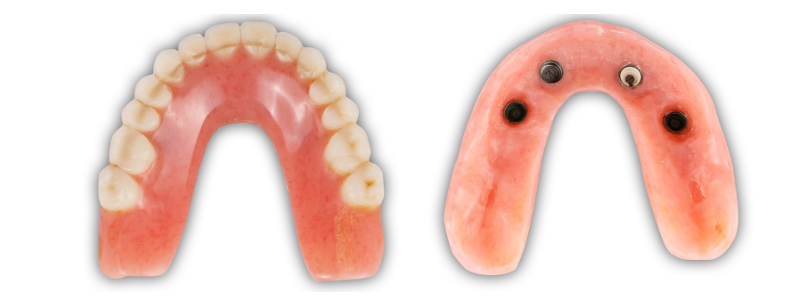 Oh Snap! Managing a Fractured Denture Base Dichter managing fractured denture base 06