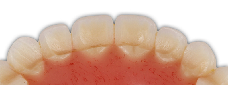 Oh Snap! Managing a Fractured Denture Base Dichter managing fractured denture base 07