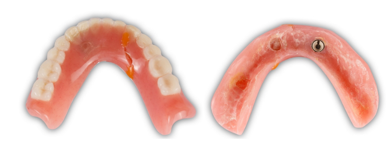 Oh Snap! Managing a Fractured Denture Base Dichter managing fractured denture base 08