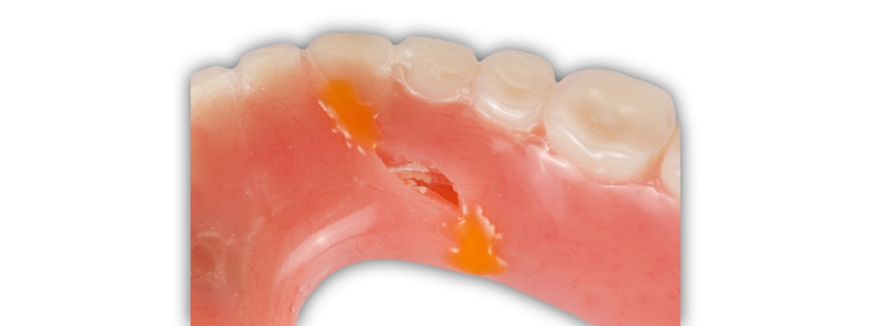 Oh Snap! Managing a Fractured Denture Base Dichter managing fractured denture base 09