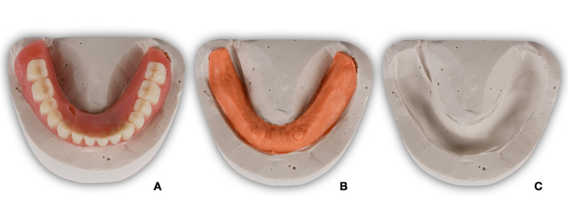 Oh Snap! Managing a Fractured Denture Base Dichter managing fractured denture base 10