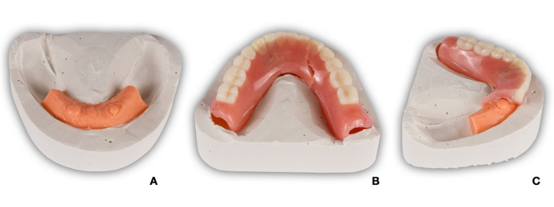 Oh Snap! Managing a Fractured Denture Base Dichter managing fractured denture base 11