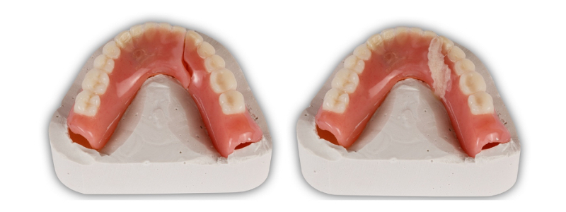Oh Snap! Managing a Fractured Denture Base Dichter managing fractured denture base 12