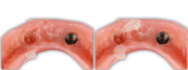 Oh Snap! Managing a Fractured Denture Base Dichter managing fractured denture base 13