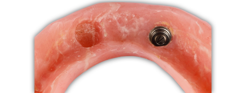 Oh Snap! Managing a Fractured Denture Base Dichter managing fractured denture base 14