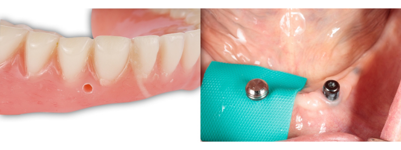 Oh Snap! Managing a Fractured Denture Base Dichter managing fractured denture base 15