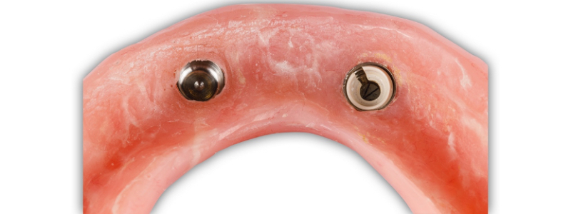 Oh Snap! Managing a Fractured Denture Base Dichter managing fractured denture base 16