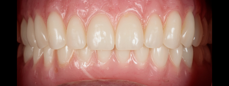 Oh Snap! Managing a Fractured Denture Base DigestIMG FracturedDentureBase 18