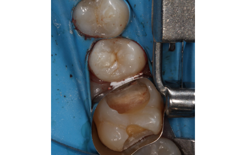 Benefits of Deep Margin Elevation for Treating Subgingival Margins Janiga The Belknap Band Figure 12