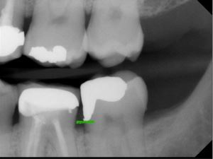 Benefits of Deep Margin Elevation for Treating Subgingival Margins Janiga benefits deep margin elevation 01