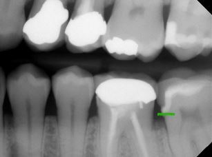 Benefits of Deep Margin Elevation for Treating Subgingival Margins Janiga benefits deep margin elevation 02