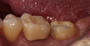 Benefits of Deep Margin Elevation for Treating Subgingival Margins Janiga benefits deep margin elevation 03 1