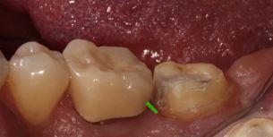 Benefits of Deep Margin Elevation for Treating Subgingival Margins Janiga benefits deep margin elevation 04