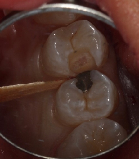 Benefits of Deep Margin Elevation for Treating Subgingival Margins Janiga benefits deep margin elevation 05