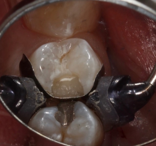 Benefits of Deep Margin Elevation for Treating Subgingival Margins Janiga benefits deep margin elevation 06