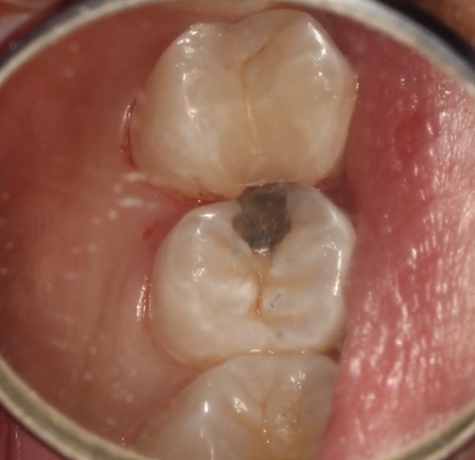 Benefits of Deep Margin Elevation for Treating Subgingival Margins Janiga benefits deep margin elevation 07