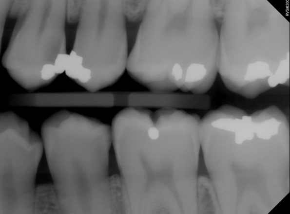 Benefits of Deep Margin Elevation for Treating Subgingival Margins Janiga benefits deep margin elevation 08
