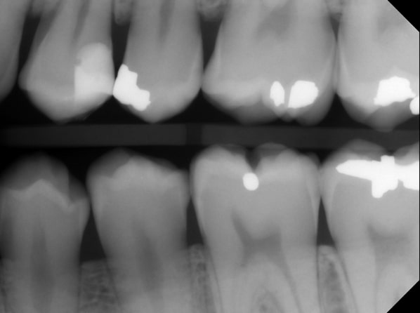 Benefits of Deep Margin Elevation for Treating Subgingival Margins Janiga benefits deep margin elevation 09