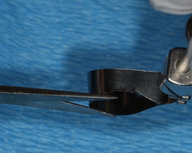 Benefits of Deep Margin Elevation for Treating Subgingival Margins Janiga benefits deep margin elevation 10 3