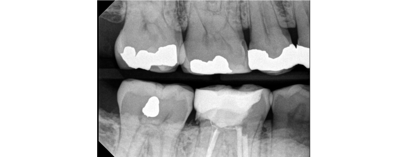 Benefits of Deep Margin Elevation for Treating Subgingival Margins Janiga benefits deep margin elevation 11