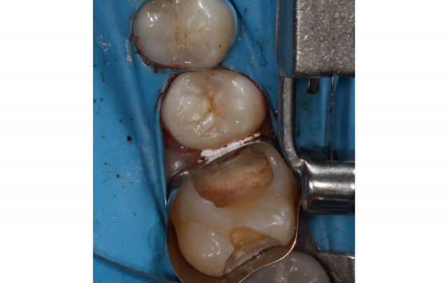 Benefits of Deep Margin Elevation for Treating Subgingival Margins