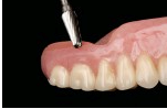 Mary Anne Salcetti reline denture 003